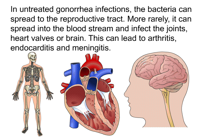 In untreated gonorrhea infections, the bacteria can spread to the reproductive tract. More rarely, it can spread into the blood stream and infect the joints, heart valves or brain. This can lead to arthritis, endocarditis and meningitis.