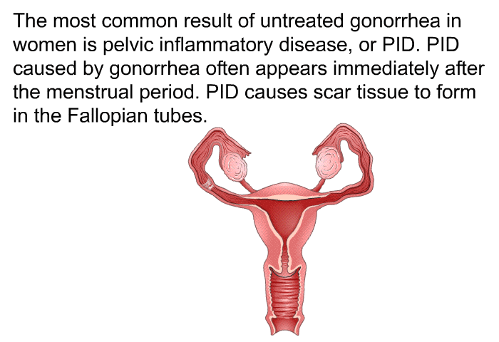 The most common result of untreated gonorrhea in women is pelvic inflammatory disease, or PID. PID caused by gonorrhea often appears immediately after the menstrual period. PID causes scar tissue to form in the Fallopian tubes.