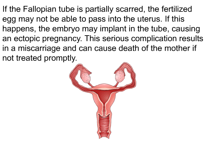 If the Fallopian tube is partially scarred, the fertilized egg may not be able to pass into the uterus. If this happens, the embryo may implant in the tube, causing an ectopic pregnancy. This serious complication results in a miscarriage and can cause death of the mother if not treated promptly.