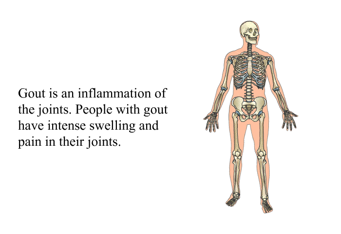 Gout is an inflammation of the joints. People with gout have intense swelling and pain in their joints.