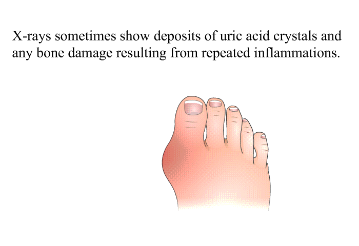 X-rays sometimes show deposits of uric acid crystals and any bone damage resulting from repeated inflammations.