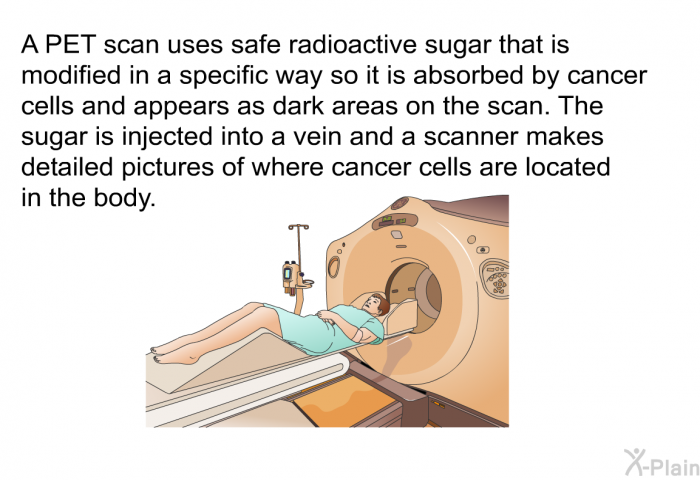 A PET scan uses safe radioactive sugar that is modified in a specific way so it is absorbed by cancer cells and appears as dark areas on the scan. The sugar is injected into a vein and a scanner makes detailed pictures of where cancer cells are located in the body.