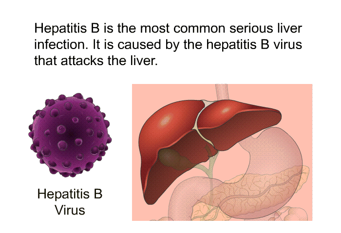 Hepatitis B is the most common serious liver infection. It is caused by the hepatitis B virus that attacks the liver.