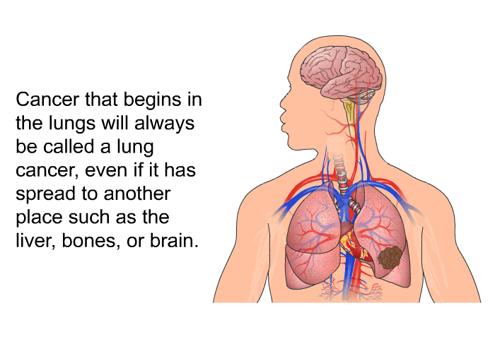Cancer that begins in the lungs will always be called a lung cancer, even if it has spread to another place such as the liver, bones, or brain.
