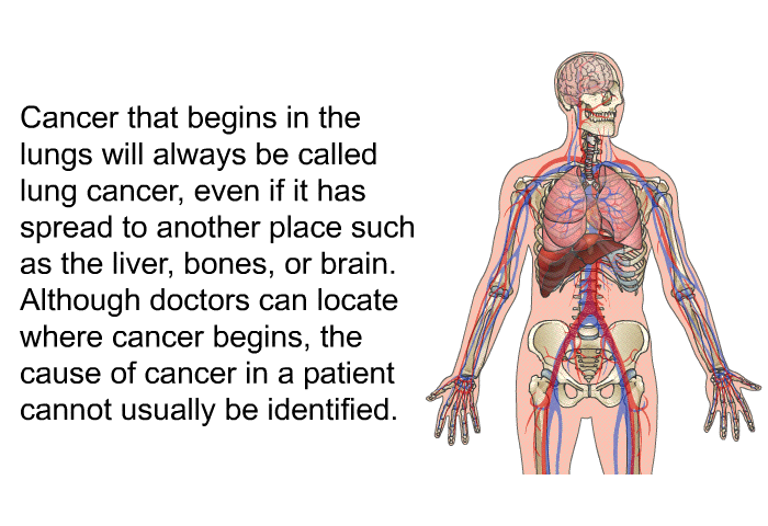 Cancer that begins in the lungs will always be called lung cancer, even if it has spread to another place such as the liver, bones, or brain. Although doctors can locate where cancer begins, the cause of cancer in a patient cannot usually be identified.