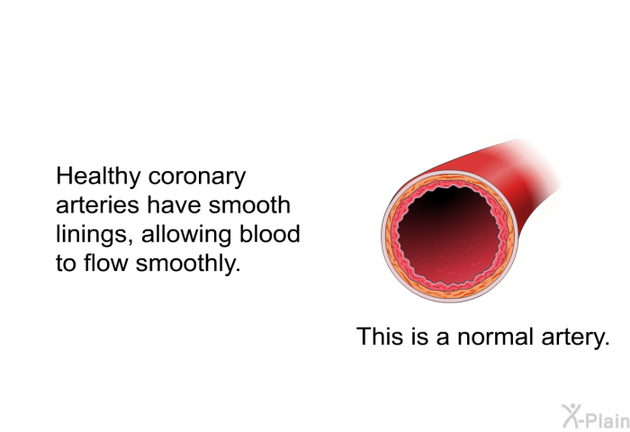 Healthy coronary arteries have smooth linings, allowing blood to flow smoothly.