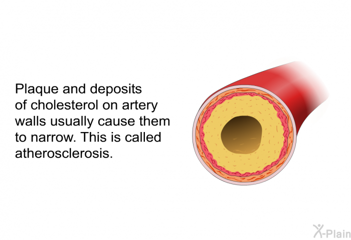 Plaque and deposits of cholesterol on artery walls usually cause them to narrow. This is called atherosclerosis.