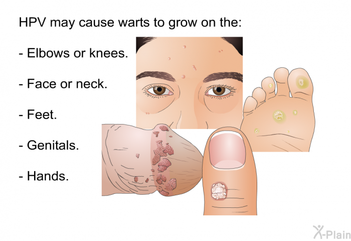 HPV may cause warts to grow on the:  Elbows or knees. Face or neck. Feet. Genitals. Hands.