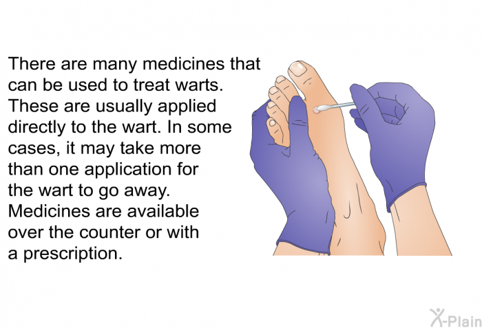 There are many medicines that can be used to treat warts. These are usually applied directly to the wart. In some cases, it may take more than one application for the wart to go away. Medicines are available over the counter or with a prescription.