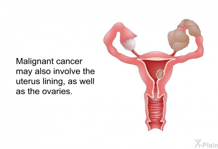 Malignant cancer may also involve the uterus lining, as well as the ovaries.