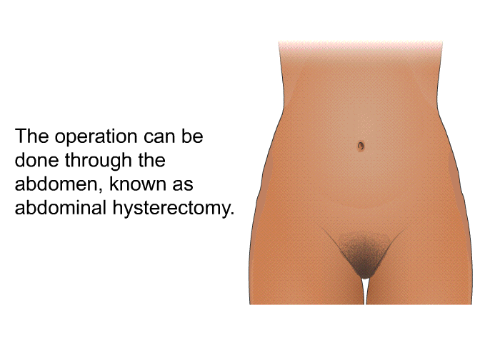 The operation can be done through the abdomen, known as abdominal hysterectomy.
