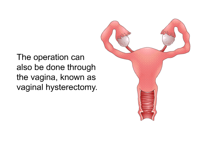 The operation can also be done through the vagina, known as vaginal hysterectomy.
