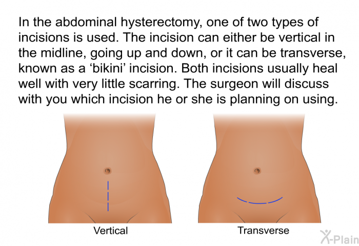 In the abdominal hysterectomy, one of two types of incisions is used. The incision can either be vertical in the midline, going up and down, or it can be transverse, known as a  bikini' incision. Both incisions usually heal well with very little scarring. The surgeon will discuss with you which incision he or she is planning on using.