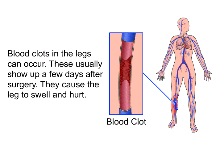 Blood clots in the legs can occur. These usually show up a few days after surgery. They cause the leg to swell and hurt.