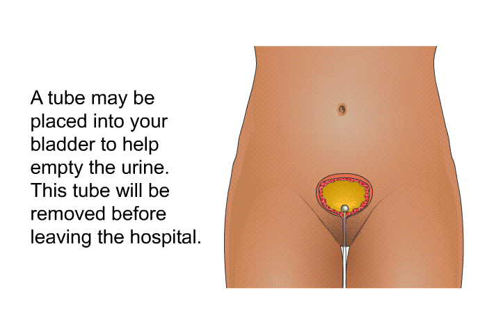 A tube may be placed into your bladder to help empty the urine. This tube will be removed before leaving the hospital.