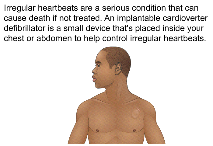 Irregular heartbeats are a serious condition that can cause death if not treated. An implantable cardioverter defibrillator is a small device that's placed inside your chest or abdomen to help control irregular heartbeats.