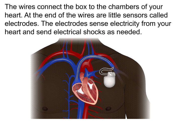 The wires connect the box to the chambers of your heart. At the end of the wires are little sensors called electrodes. The electrodes sense electricity from your heart and send electrical shocks as needed.