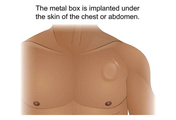 The metal box is implanted under the skin of the chest or abdomen.