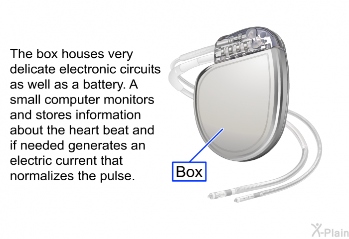 The box houses very delicate electronic circuits as well as a battery. A small computer monitors and stores information about the heart beat and if needed generates an electric current that normalizes the pulse.