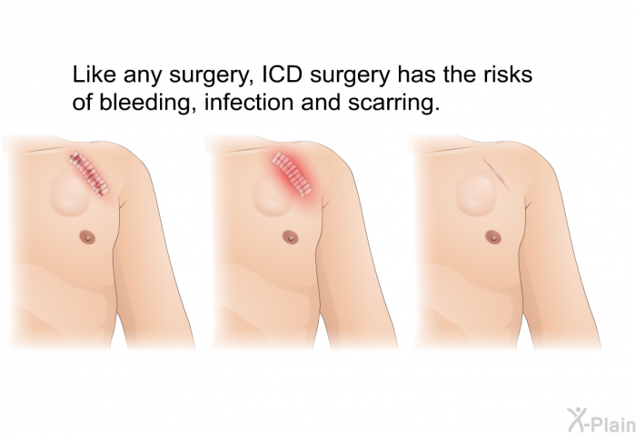 Like any surgery, ICD surgery has the risks of bleeding, infection and scarring.