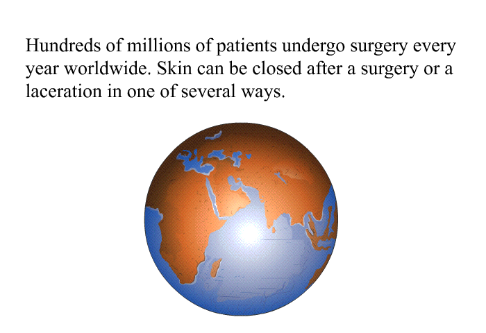 Hundreds of millions of patients undergo surgery every year worldwide. Skin can be closed after a surgery or a laceration in one of several ways.