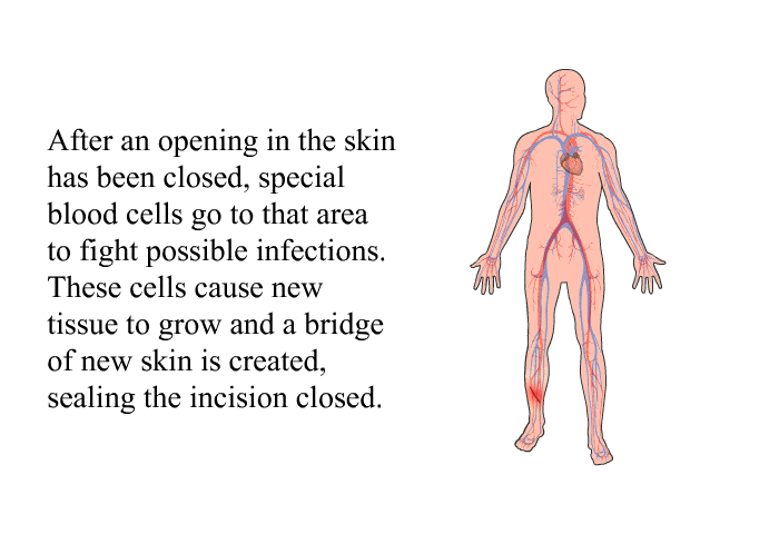 After an opening in the skin has been closed, special blood cells go to that area to fight possible infections. These cells cause new tissue to grow and a bridge of new skin is created, sealing the incision closed.