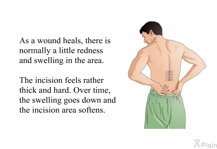 As a wound heals, there is normally a little redness and swelling in the area. The incision feels rather thick and hard. Over time, the swelling goes down and the incision area softens.