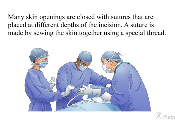 Many skin openings are closed with sutures that are placed at different depths of the incision. A suture is made by sewing the skin together using a special thread.