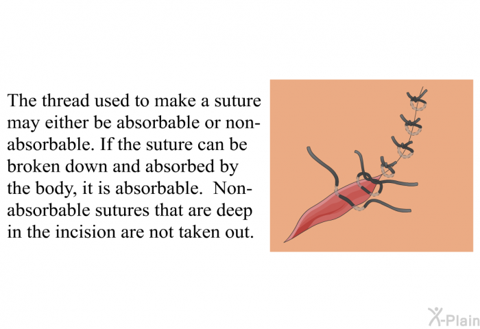 The thread used to make a suture may either be absorbable or non-absorbable. If the suture can be broken down and absorbed by the body, it is absorbable. Non-absorbable sutures that are deep in the incision are not taken out.