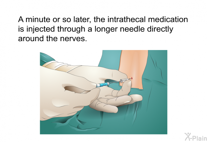 A minute or so later, the intrathecal medication is injected through a longer needle directly around the nerves.