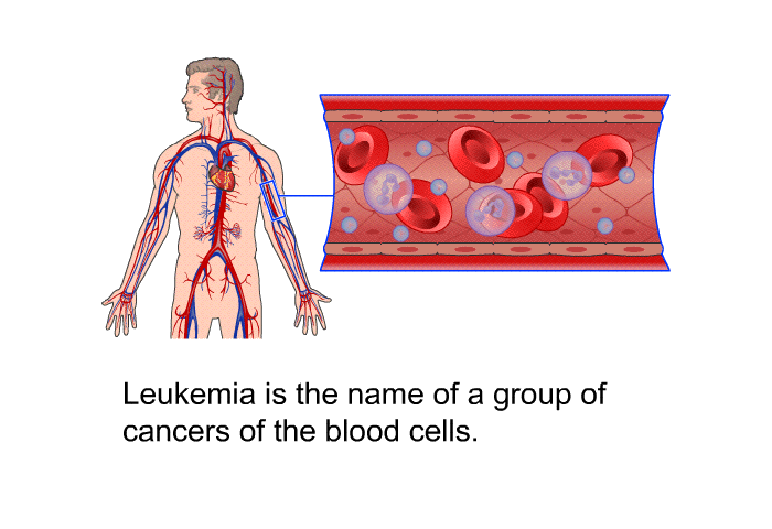 Leukemia is the name of a group of cancers of the blood cells.