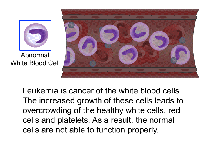 Leukemia is cancer of the white blood cells. The increased growth of these cells leads to overcrowding of the healthy white cells, red cells and platelets. As a result, the normal cells are not able to function properly.
