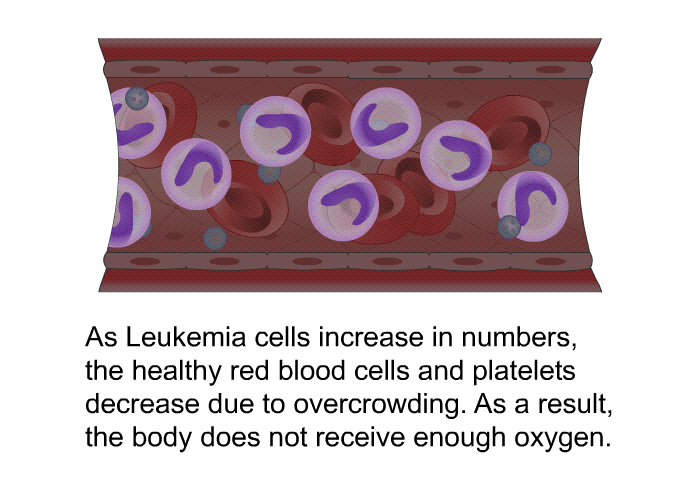 As Leukemia cells increase in numbers, the healthy red blood cells and platelets decrease due to overcrowding. As a result, the body does not receive enough oxygen.