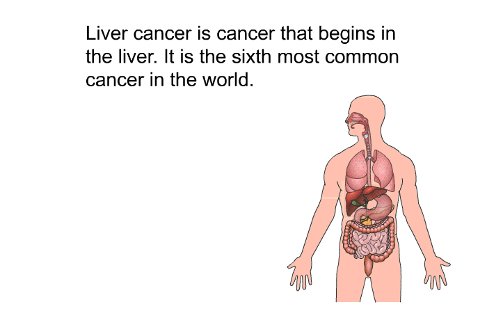 Liver cancer is cancer that begins in the liver. It is the sixth most common cancer in the world.