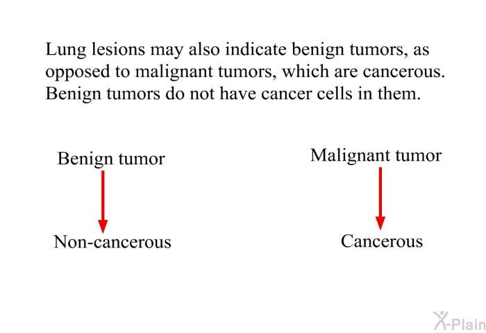 Benign Tumor Lung Cancer