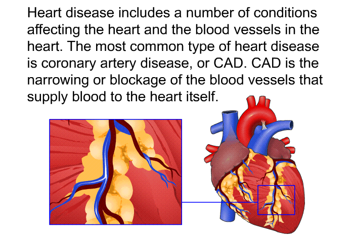 Heart disease includes a number of conditions affecting the heart and the blood vessels in the heart. The most common type of heart disease is coronary artery disease, or CAD. CAD is the narrowing or blockage of the blood vessels that supply blood to the heart itself.