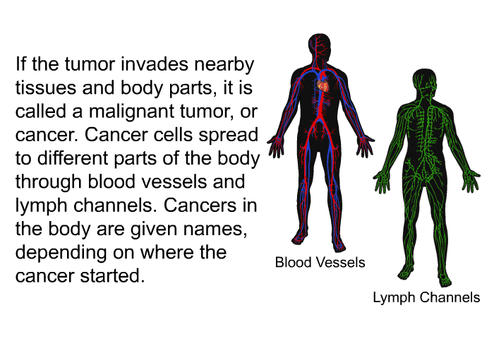 If the tumor invades nearby tissues and body parts, it is called a malignant tumor, or cancer. Cancer cells spread to different parts of the body through blood vessels and lymph channels. Cancers in the body are given names, depending on where the cancer started.