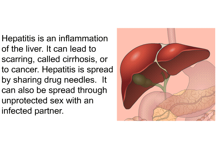 Hepatitis is an inflammation of the liver. It can lead to scarring, called cirrhosis, or to cancer. Hepatitis is spread by sharing drug needles. It can also be spread through unprotected sex with an infected partner.