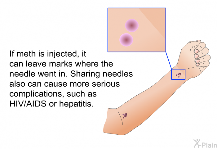 If meth is injected, it can leave marks where the needle went in. Sharing needles also can cause more serious complications, such as HIV/AIDS or hepatitis.