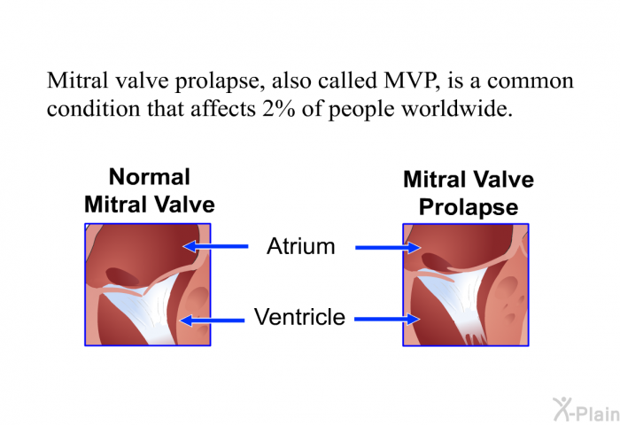 Mitral valve prolapse, also called MVP, is a common condition that affects 2% of people worldwide.