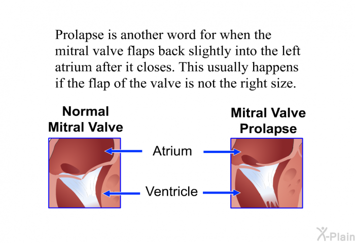 Prolapse is another word for when the mitral valve flaps back slightly into the left atrium after it closes. This usually happens if the flap of the valve is not the right size.