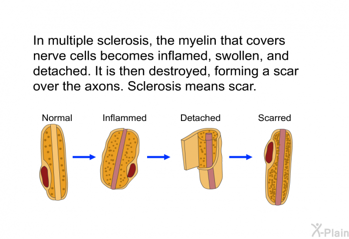 In multiple sclerosis, the myelin that covers nerve cells becomes inflamed, swollen, and detached. It is then destroyed, forming a scar over the axons. Sclerosis means scar.