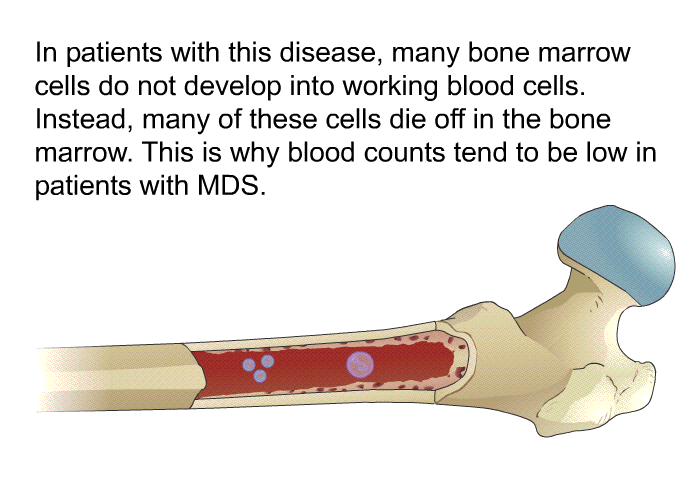 In patients with this disease, many bone marrow cells do not develop into working blood cells. Instead, many of these cells die off in the bone marrow. This is why blood counts tend to be low in patients with MDS.