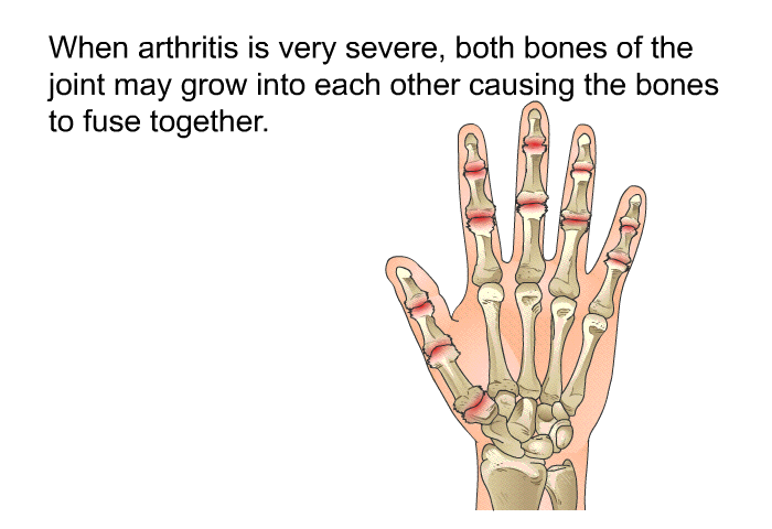 When arthritis is very severe, both bones of the joint may grow into each other causing the bones to fuse together.