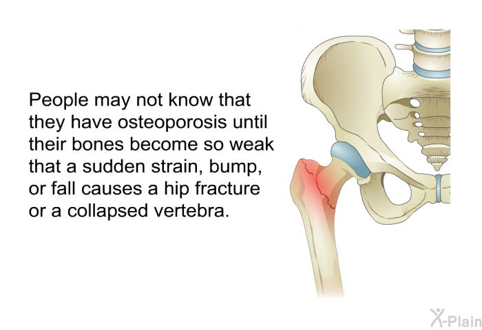 People may not know that they have osteoporosis until their bones become so weak that a sudden strain, bump, or fall causes a hip fracture or a collapsed vertebra.