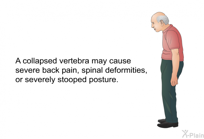 A collapsed vertebra may cause severe back pain, spinal deformities, or severely stooped posture.
