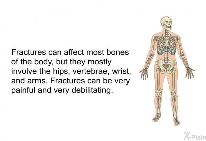 Fractures can affect most bones of the body, but they mostly involve the hips, vertebrae, wrist, and arms. Fractures can be very painful and very debilitating.