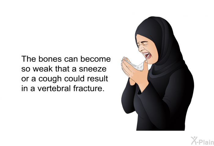 The bones can become so weak that a sneeze or a cough could result in a vertebral fracture.