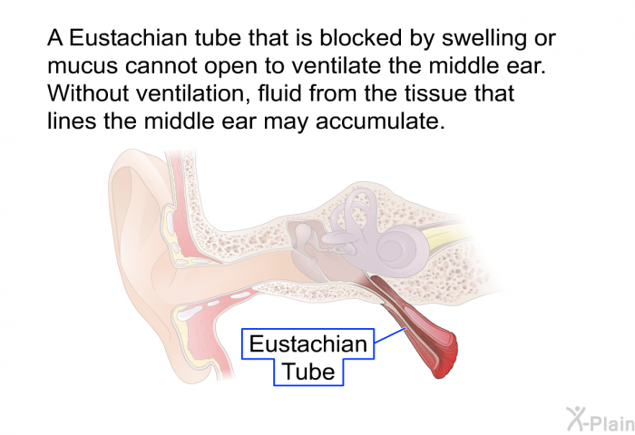 A Eustachian tube that is blocked by swelling or mucus cannot open to ventilate the middle ear. Without ventilation, fluid from the tissue that lines the middle ear may accumulate.