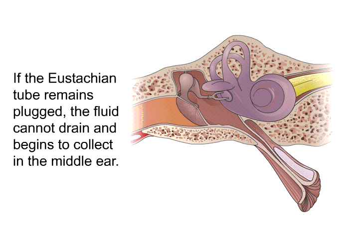 If the Eustachian tube remains plugged, the fluid cannot drain and begins to collect in the middle ear.
